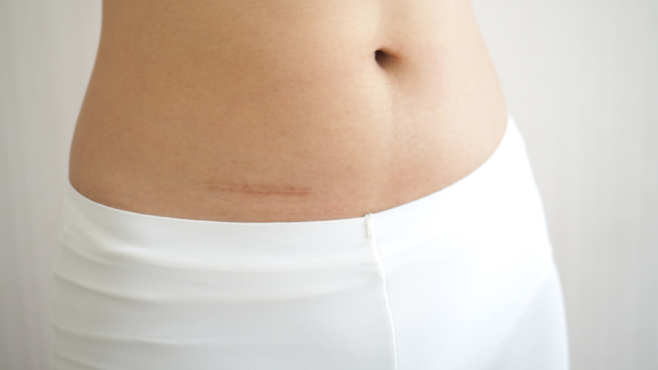 Аппендицит шрамы бар порноактриса